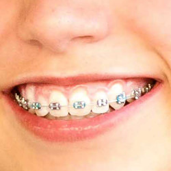 Braces