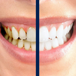 Veneers